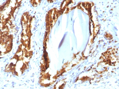 FFPE human prostate carcinoma sections stained with 100 ul anti-PSAP (clone rACPP/1338) at 1:300. HIER epitope retrieval prior to staining was performed in 10mM Citrate, pH 6.0.